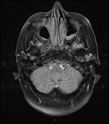 File:Bilateral acute middle cerebral artery territory infarcts (Radiopaedia 77319-89402 Axial FLAIR 5).jpg