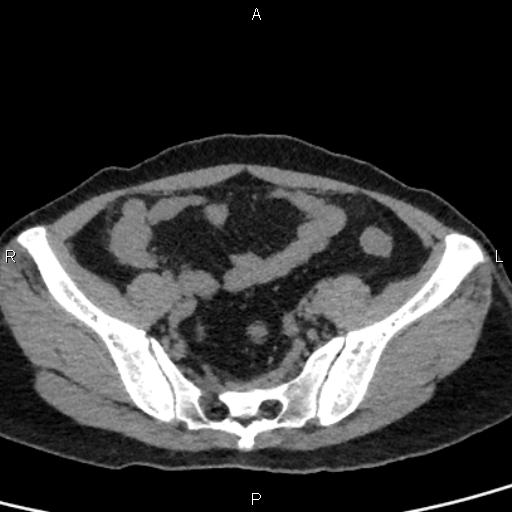 File:Bilateral adrenal gland hyperenhancement in pancreatitis (Radiopaedia 86642-102753 Axial non-contrast 89).jpg