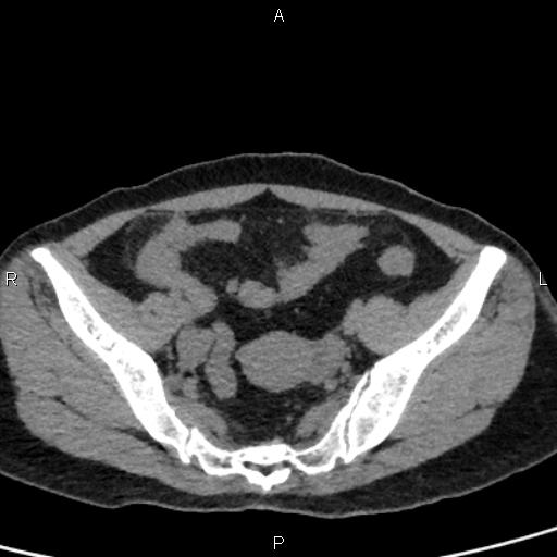 File:Bilateral adrenal gland hyperenhancement in pancreatitis (Radiopaedia 86642-102753 Axial non-contrast 91).jpg
