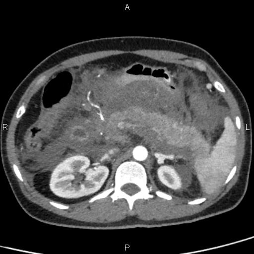 File:Bilateral adrenal gland hyperenhancement in pancreatitis (Radiopaedia 86642-102753 B 47).jpg