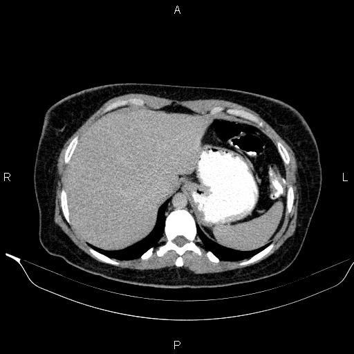 File:Bilateral adrenal myelolipoma (Radiopaedia 63058-71535 Axial C+ delayed 4).jpg