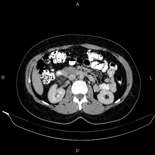 File:Bilateral adrenal myelolipoma (Radiopaedia 63058-71535 Axial C+ delayed 54).jpg