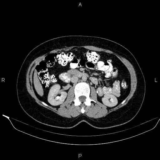 Bilateral adrenal myelolipoma (Radiopaedia 63058-71535 Axial C+ delayed 57).jpg