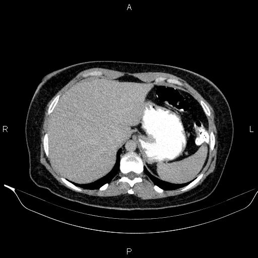 Bilateral adrenal myelolipoma (Radiopaedia 63058-71535 Axial C+ delayed 6).jpg