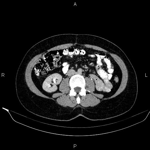Bilateral adrenal myelolipoma (Radiopaedia 63058-71535 Axial C+ delayed 72).jpg