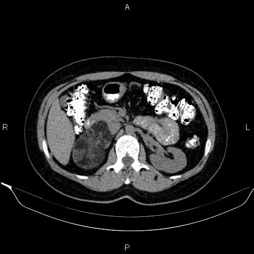 File:Bilateral adrenal myelolipoma (Radiopaedia 63058-71535 Axial non-contrast 64).jpg