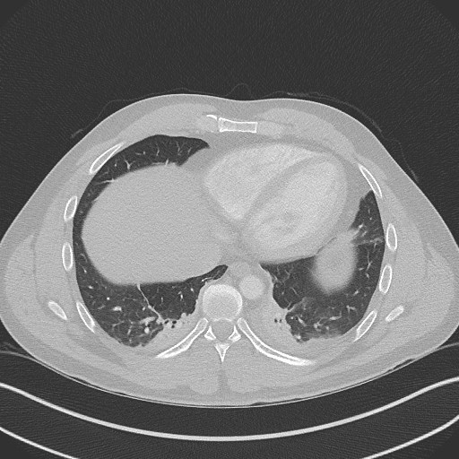 Bilateral atelectasis (Radiopaedia 48666-53675 Axial lung window 83).jpg
