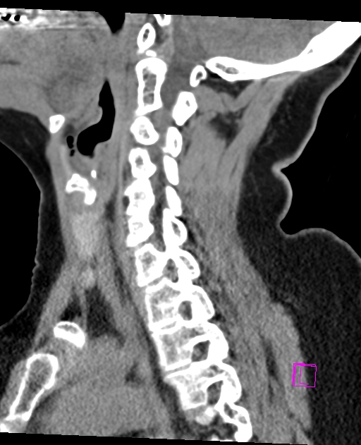 Bilateral atlanto-occipital assimilation (Radiopaedia 28350-28603 D 33).jpg