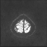 Bilateral basal ganglia and thalamic T1 hyperintensities (Radiopaedia 19764-19802 Axial DWI 38).jpg