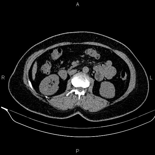 Bilateral benign adrenal adenomas (Radiopaedia 86912-103124 Axial non-contrast 54).jpg