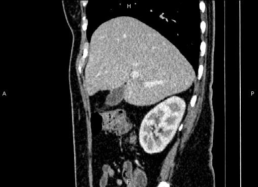 Bilateral benign adrenal adenomas (Radiopaedia 86912-103124 E 26).jpg