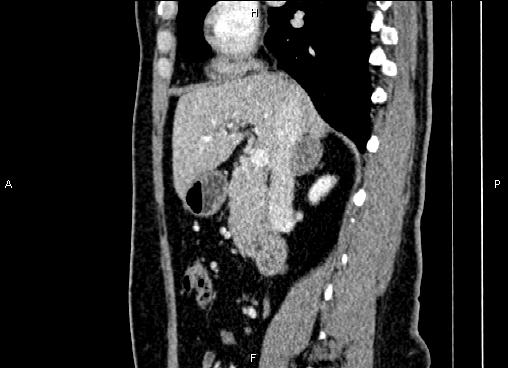 Bilateral benign adrenal adenomas (Radiopaedia 86912-103124 E 40).jpg