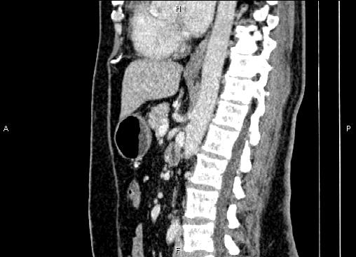Bilateral benign adrenal adenomas (Radiopaedia 86912-103124 E 53).jpg