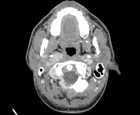 Bilateral carotid body tumors (Radiopaedia 61841-69870 Axial Post contrast 19).jpg