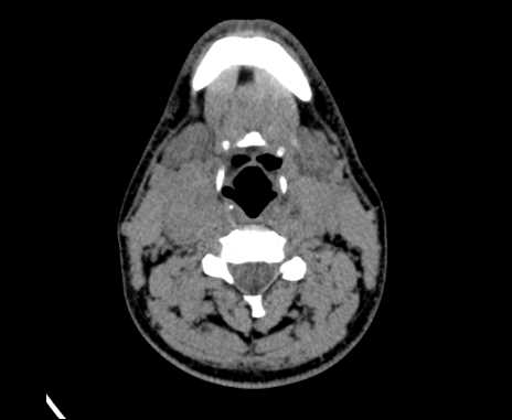 Bilateral carotid body tumors (Radiopaedia 61841-69870 Axial non-contrast 53).jpg