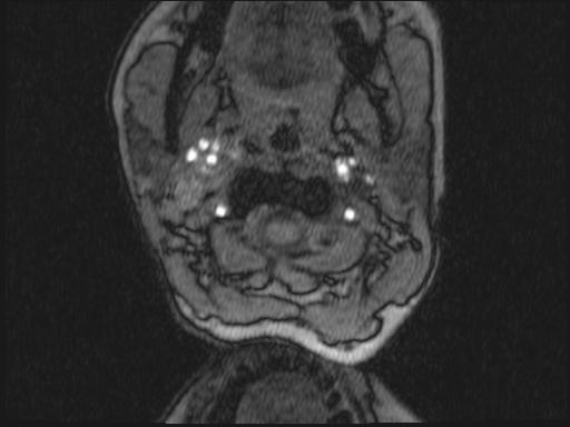 Bilateral carotid body tumors and right glomus jugulare tumor (Radiopaedia 20024-20060 Axial MRA 277).jpg