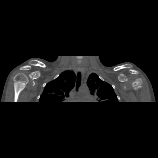 File:Bilateral chronic posterior shoulder dislocation (Radiopaedia 39213-41452 Coronal bone window 24).jpg