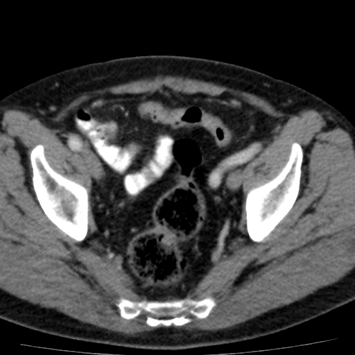 File:Bilateral direct inguinal herniae (Radiopaedia 17016-16719 B 10).jpg