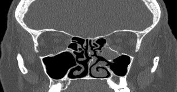 File:Bilateral ectopic infraorbital nerves (Radiopaedia 49006-54084 Coronal 28).png