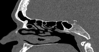 File:Bilateral ectopic infraorbital nerves (Radiopaedia 49006-54084 Sagittal 1).png
