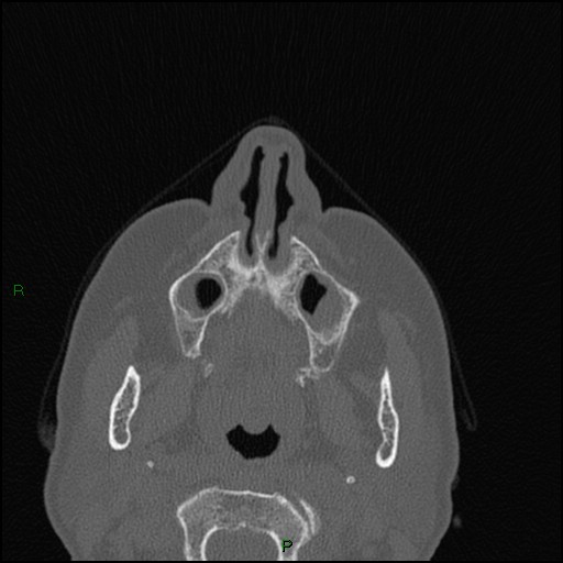Bilateral frontal mucoceles (Radiopaedia 82352-96454 Axial bone window 228).jpg