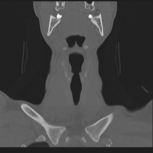 Bilateral locked facets (Radiopaedia 33850-35016 Coronal bone window 19).png