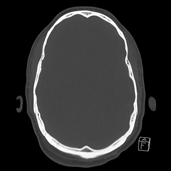 Bilateral occipital condyle fracture (type 2) (Radiopaedia 87675-104089 Axial bone window 59).jpg