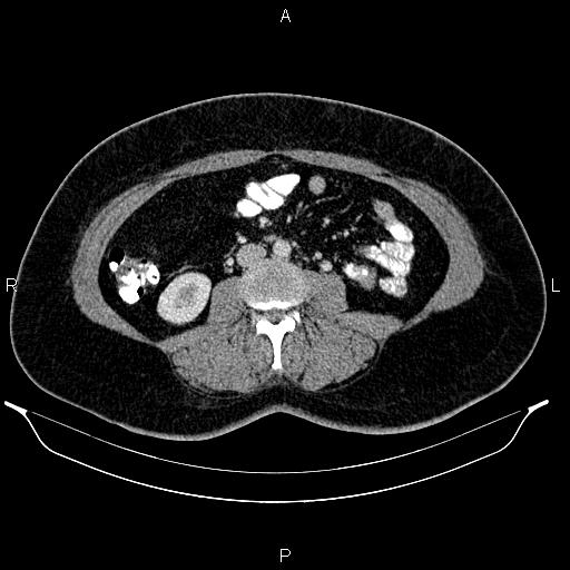 Bilateral ovarian dermoid cysts (Radiopaedia 85785-101603 A 59).jpg