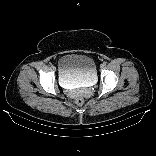 Bilateral ovarian dermoid cysts (Radiopaedia 85785-101603 Axial C+ delayed 79).jpg