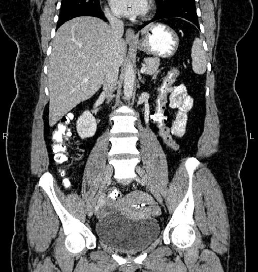 Bilateral ovarian dermoid cysts (Radiopaedia 85785-101603 C 29).jpg