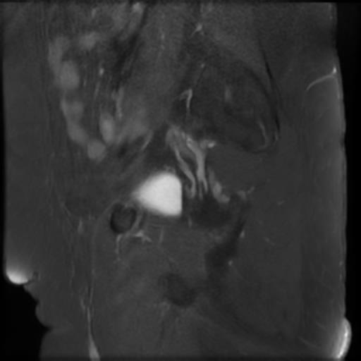 File:Bilateral ovarian dermoid cysts (Radiopaedia 90152-107338 Sagittal T1 C+ 5).jpg