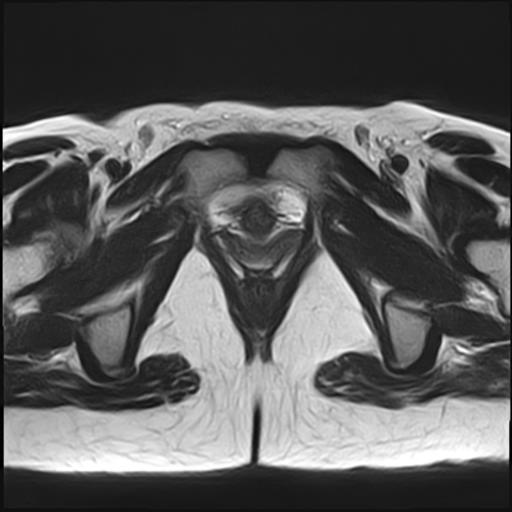 File:Bilateral ovarian endometriomas (Radiopaedia 87085-103347 Axial T2 20).jpg