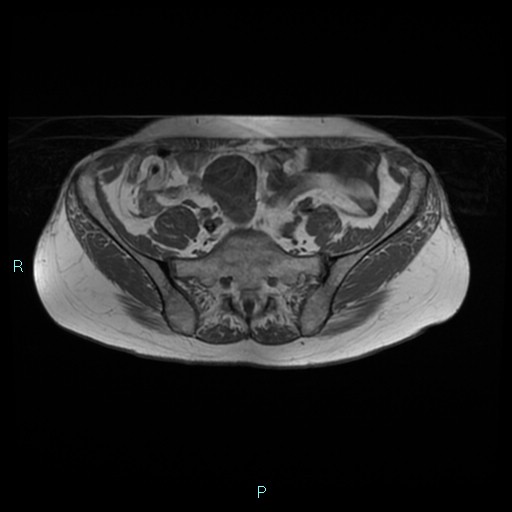 File:Bilateral ovarian fibroma (Radiopaedia 44568-48293 Axial T1 5).jpg