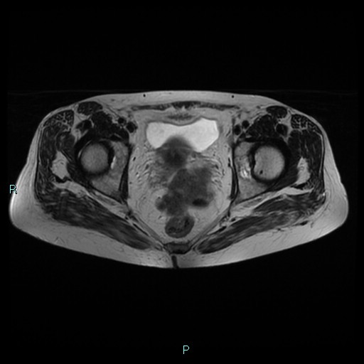 File:Bilateral ovarian fibroma (Radiopaedia 44568-48293 Axial T2 19).jpg