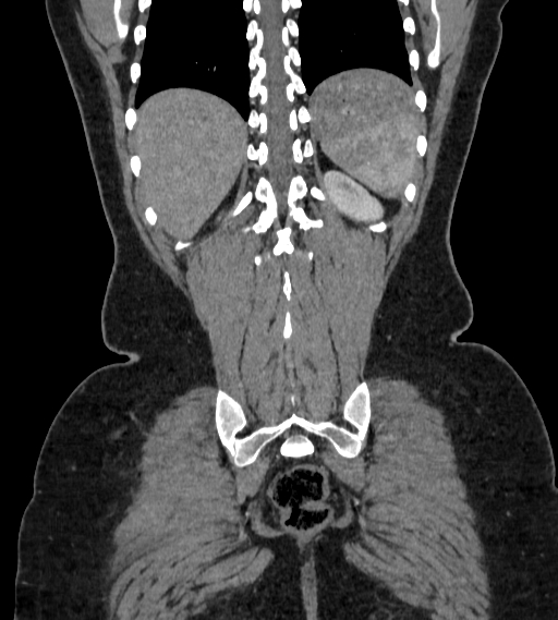 Bilateral ovarian mature cystic teratomas (Radiopaedia 79373-92457 B 89).jpg