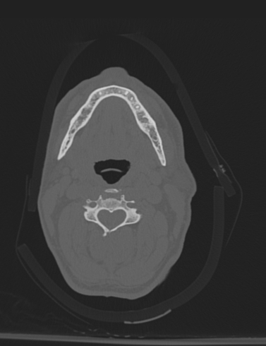 Bilateral perched facet joint (Radiopaedia 63149-71669 Axial bone window 18).jpg