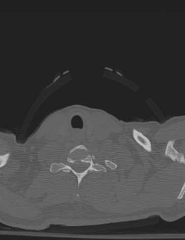 Bilateral perched facet joint (Radiopaedia 63149-71669 Axial bone window 57).jpg