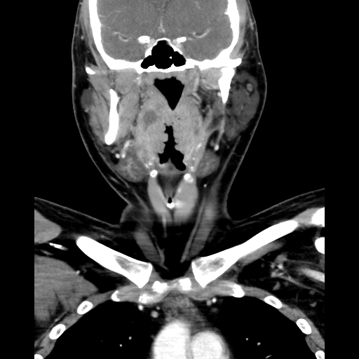 Bilateral peritonsillar abscess (Radiopaedia 85065-100610 Coronal 34).jpg