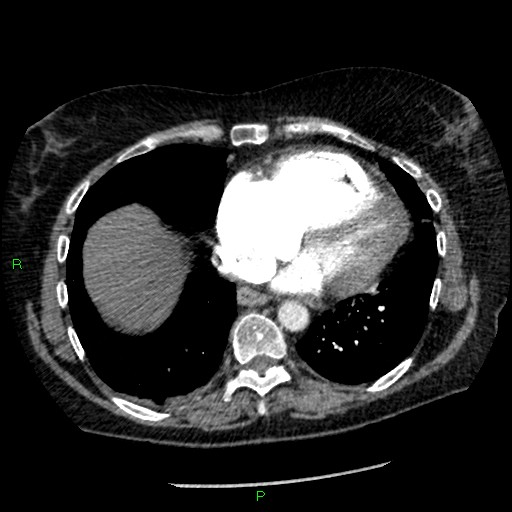 Bilateral pulmonary emboli (Radiopaedia 32700-33669 Axial C+ CTPA 78).jpg