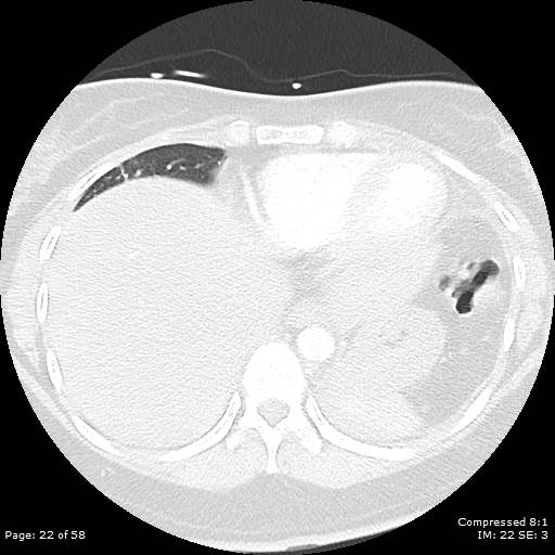 Bilateral pulmonary emboli with Hampton hump sign (Radiopaedia 54070-60246 Axial lung window 22).jpg