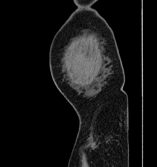 Bilateral rectus sheath hematomas (Radiopaedia 50778-56252 B 78).jpg