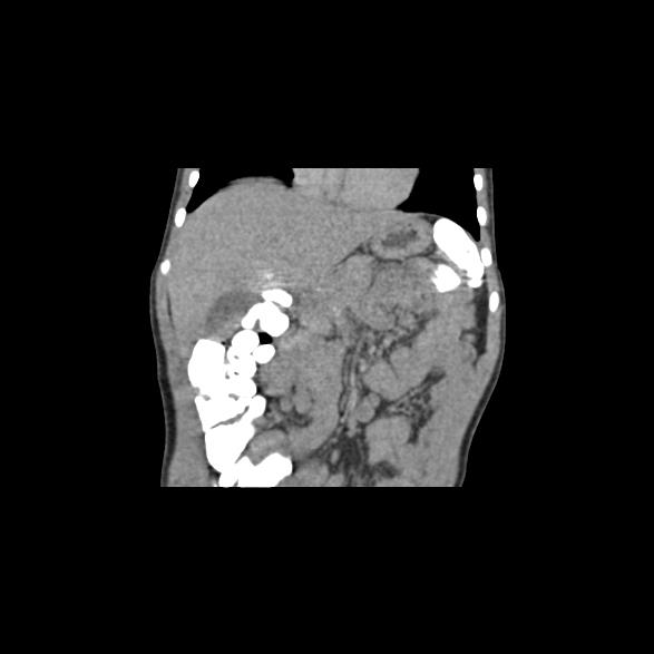 File:Bilateral renal malrotation (Radiopaedia 30901-31606 B 56).jpg