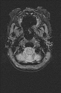 File:Bilateral subdural hemorrhage and parietal skull fracture (Radiopaedia 26058-26190 Axial SWI 4).png