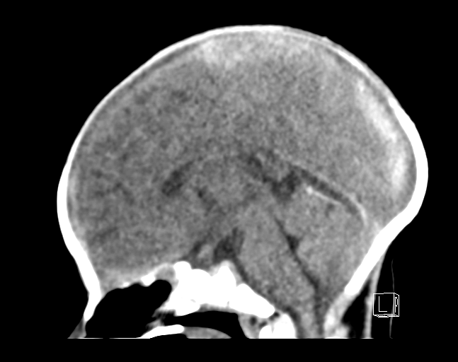File:Bilateral subdural hemorrhage and parietal skull fracture (Radiopaedia 26058-26192 C 12).png