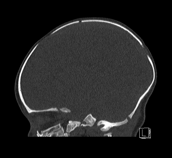 Bilateral subdural hemorrhage and parietal skull fracture (Radiopaedia 26058-26192 Sagittal bone window 60).png