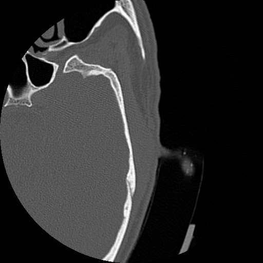 Bilateral temporal bone fractures (Radiopaedia 29482-29970 D 133).jpg
