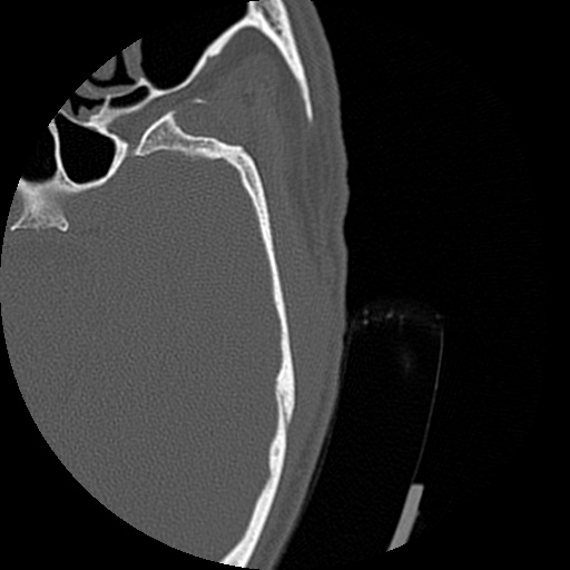 Bilateral temporal bone fractures (Radiopaedia 29482-29970 D 137).jpg
