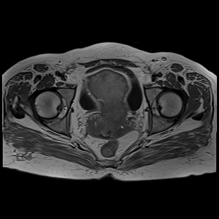 Bilateral tubo-ovarian abscesses (Radiopaedia 58635-65829 Axial T1 C+ 35).jpg