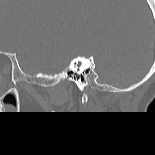 Bilateral tympanoplasty (Radiopaedia 16947-16664 Sagittal bone window 41).jpg