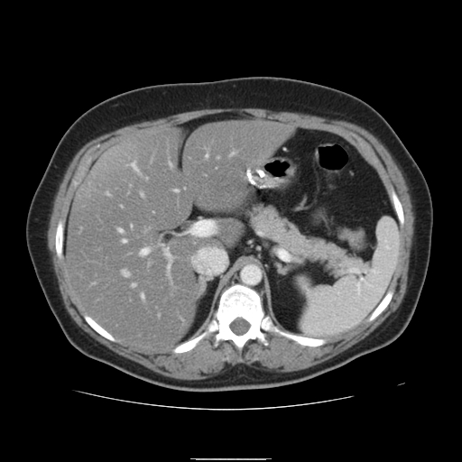 File:Billroth I gastric resection (Radiopaedia 17685-17425 None 7).jpg